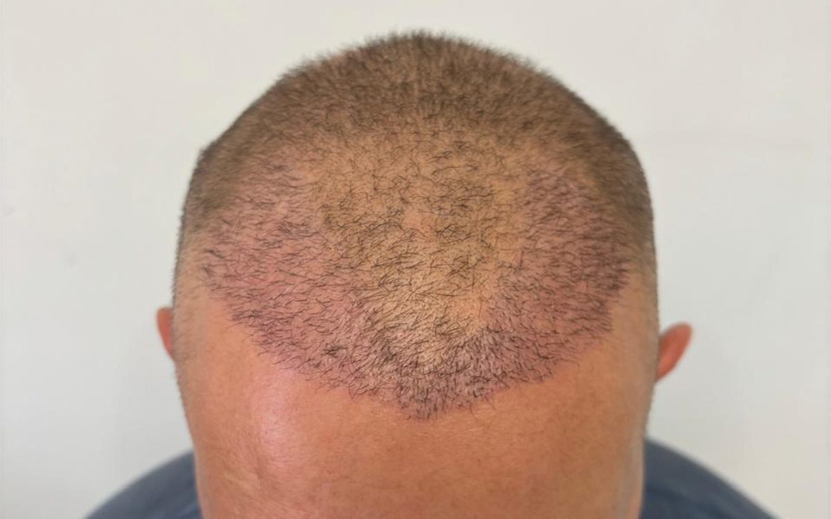 1 Month Post Transplant 2000 Grafts After