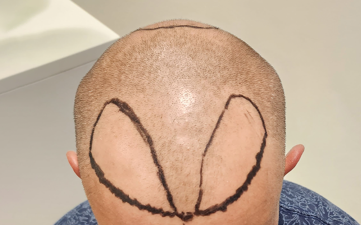 1 Month Post Transplant 2000 Grafts Before