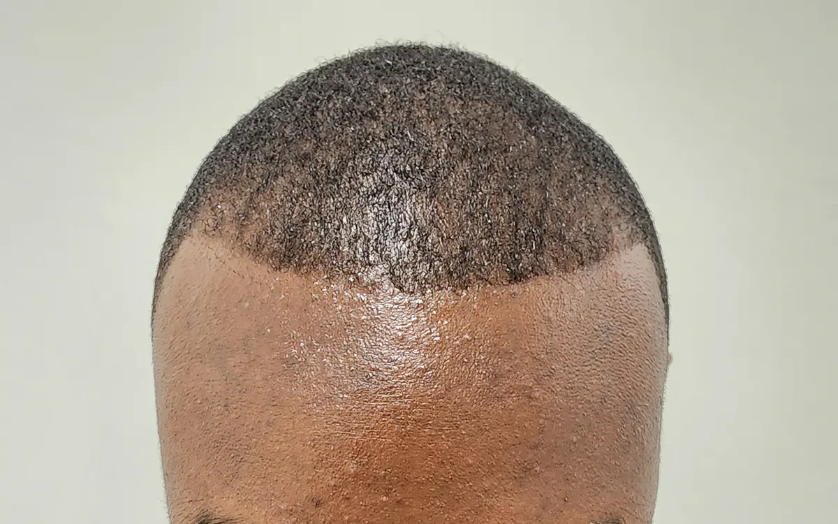 1 Year Post Transplant 1600 Grafts After