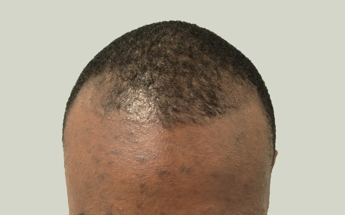1 Year Post Transplant 1600 Grafts Before