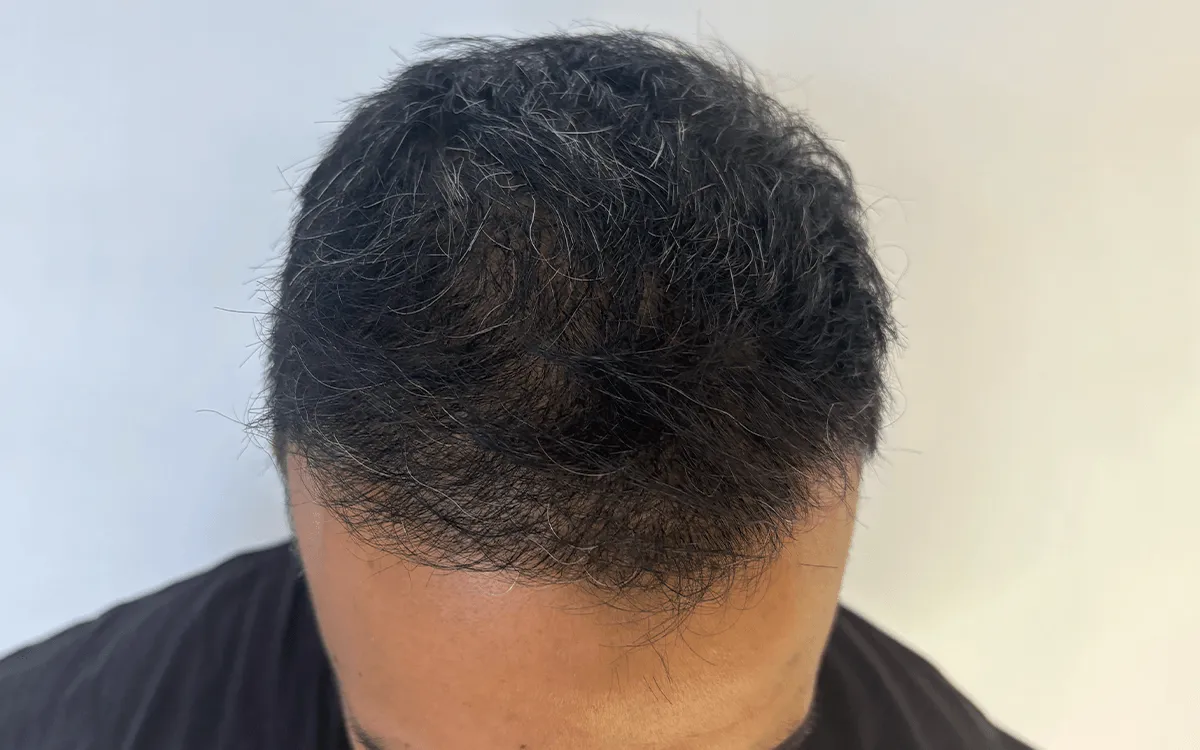 5 Month Post Transplant 3200 Grafts After