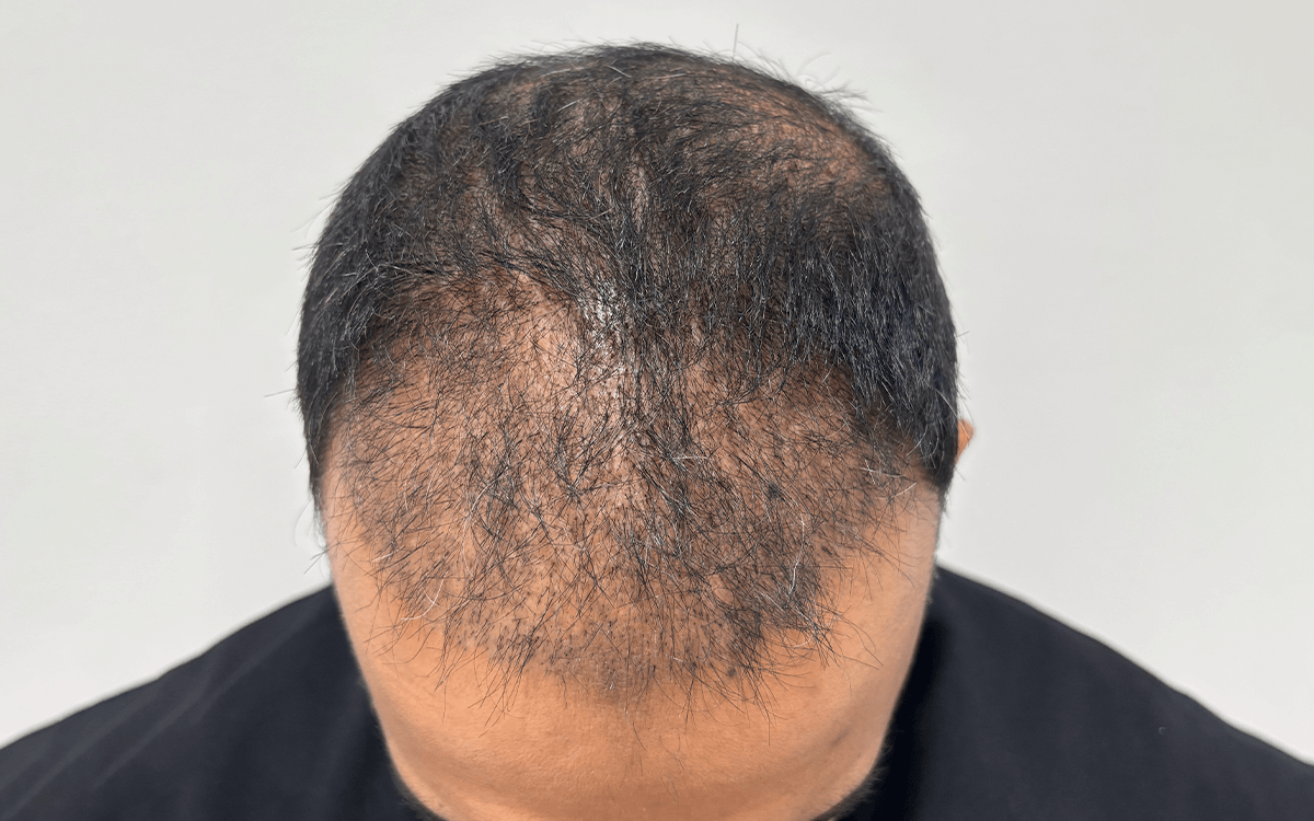 5 Month Post Transplant 3200 Grafts Before