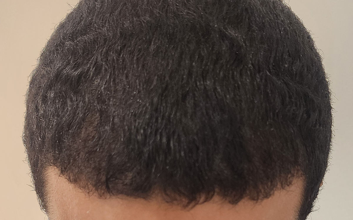 6 Months Post Transplant 1120 Grafts After