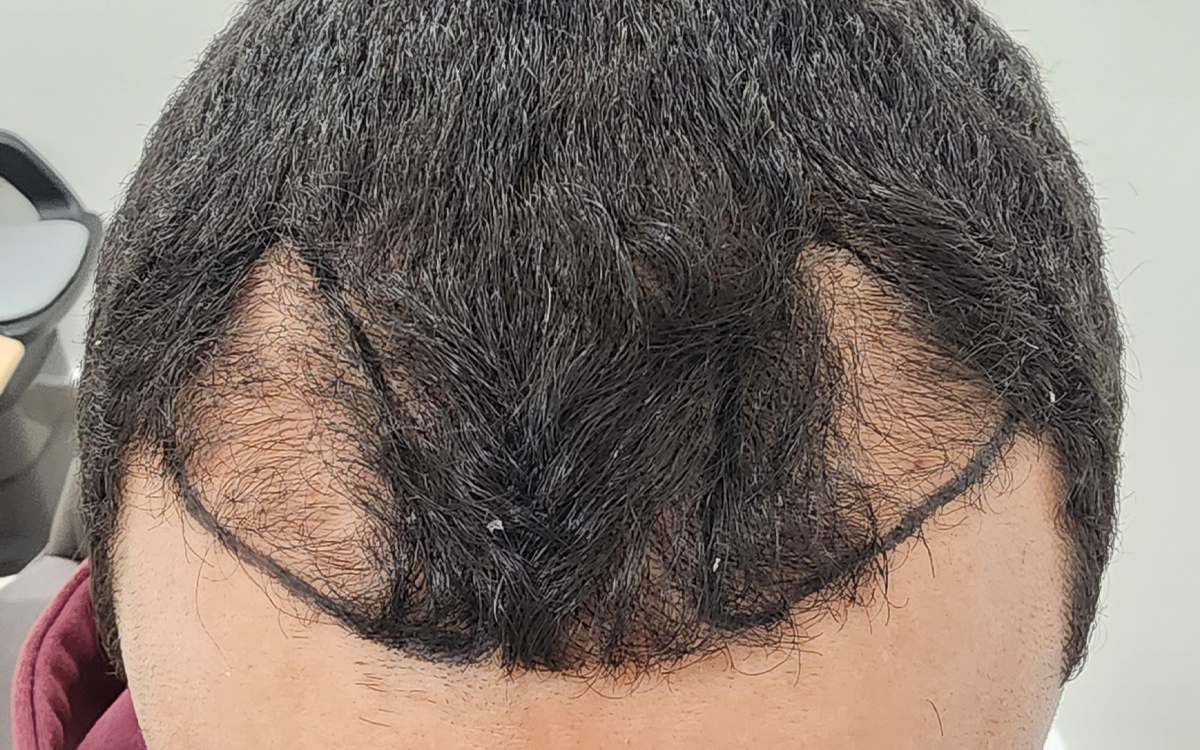 6 Months Post Transplant 1120 Grafts Before