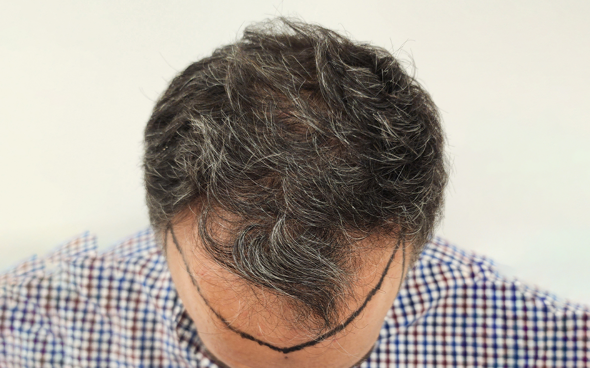 6 Months Post Transplant 2000 Grafts Before