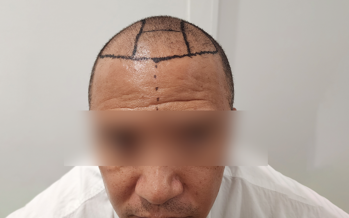 6 Months Post Transplant 3000 Grafts Before