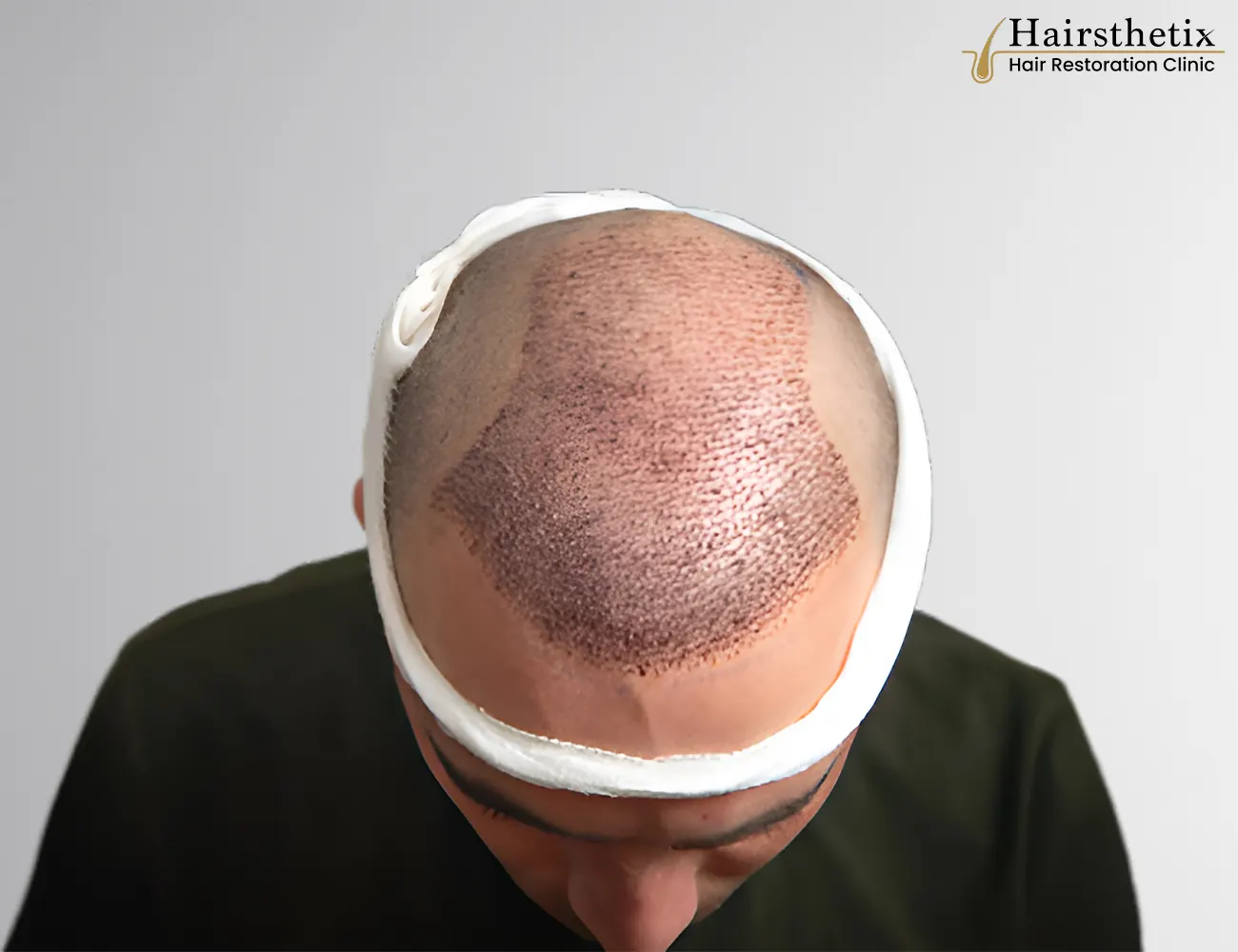 FUE Hair Transplant procedure